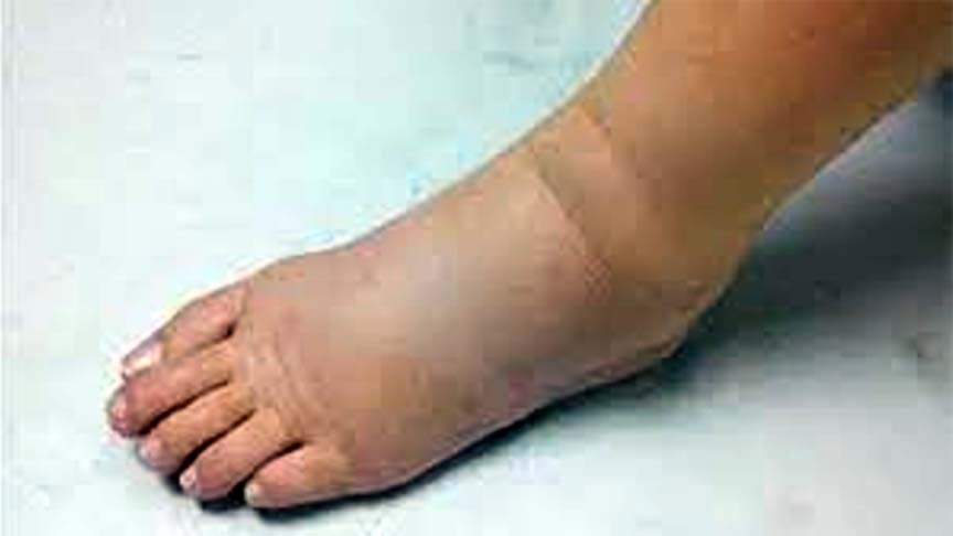 Anti-filariasis campaign sarwadhik news फाइलेरिया रोधी अभियान दस फरवरी से खिलायी जायेगी फाइलेरिया की दवा 1